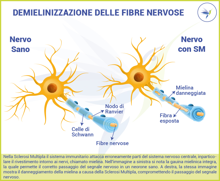 Demielinizzazione-fibre-nervose_Blog_Nutrizionista.Bio