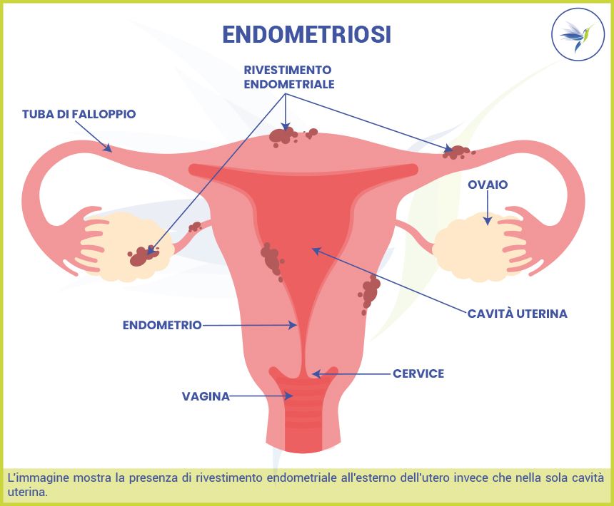 Endometriosi