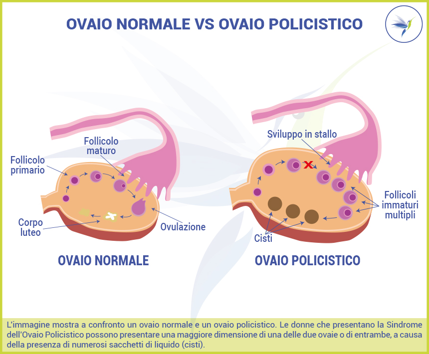 Ovaio-normale-vs-ovaio-policistico_Blog_Nutrizionista.Bio