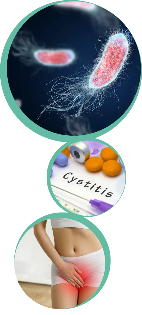 cistite1
