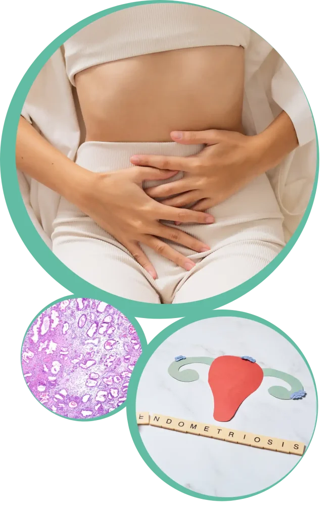 endometriosi