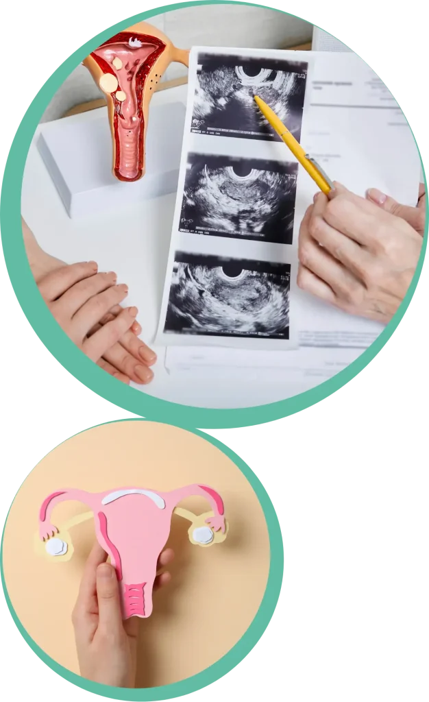 pcos 1