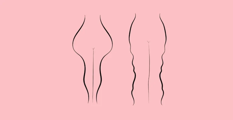 lipedema