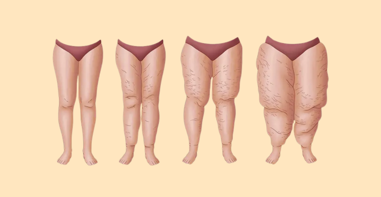 lipedema e dimagrimento